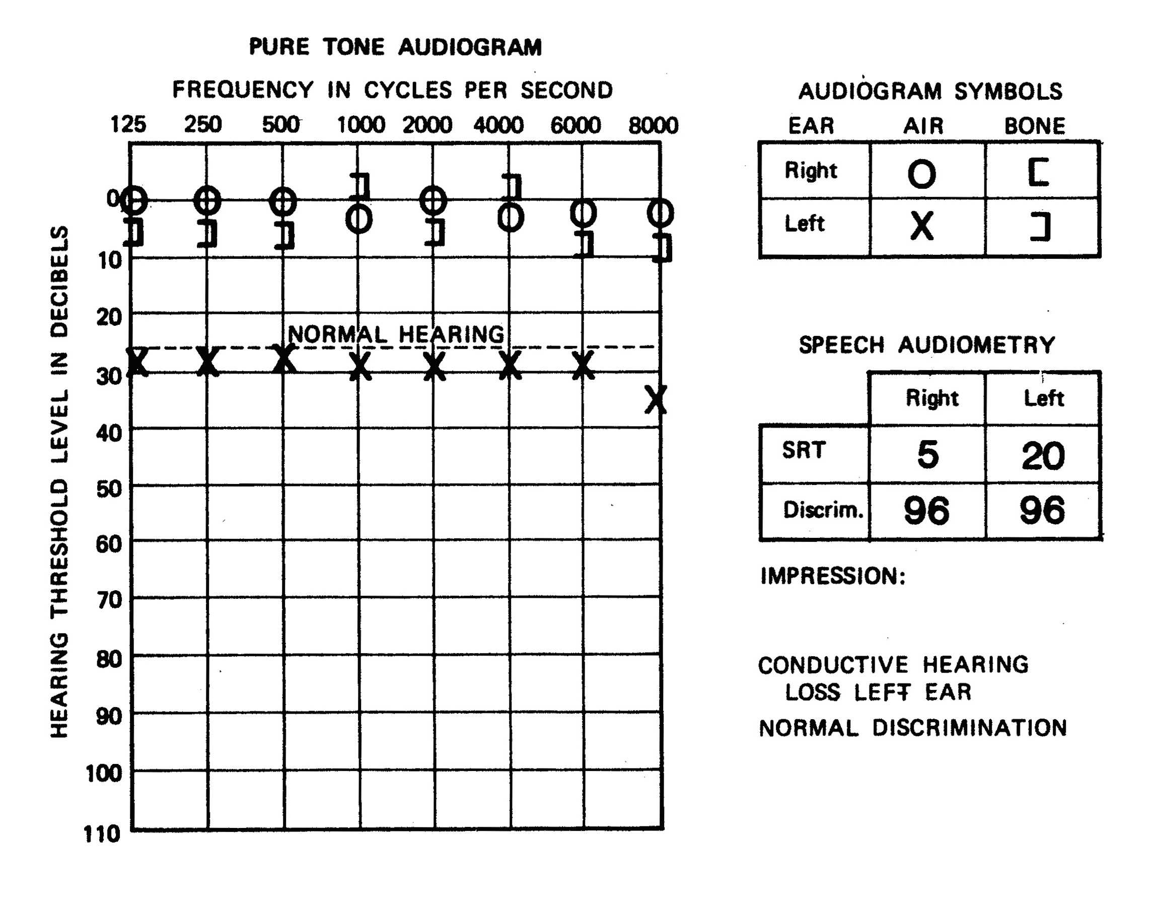 1000 Images About Audiology On Pinterest Pitch Cochlear In Blank Audiogram Template Download