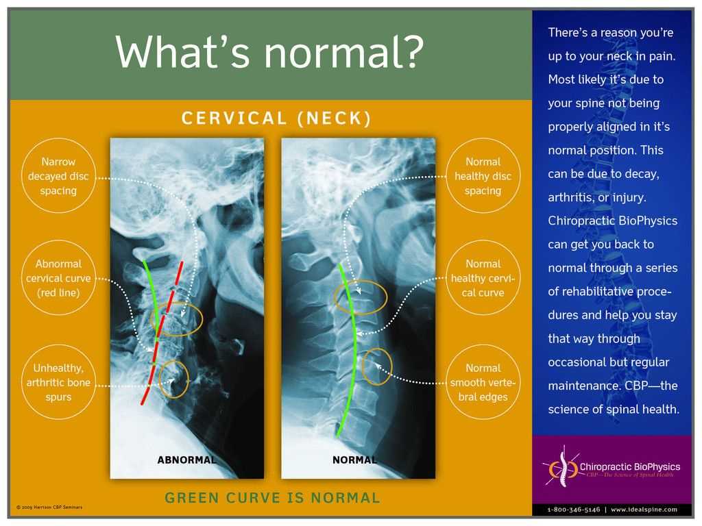 Normal Vs. Abnormal Cervical X Ray – Chiropractic Biophysics Pertaining To Chiropractic X Ray Report Template